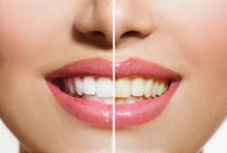 Teeth Whitening Teeth Whitening