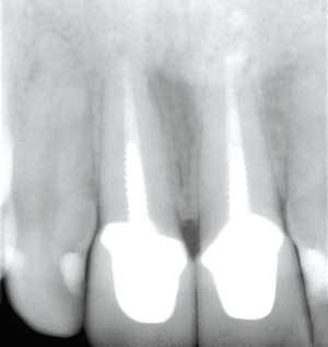Metal Free Restorations 2006 All Ceramic Update Dental Economics