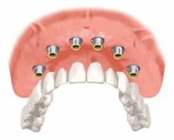 Th 0612dedentures02 Th 0612dedentures02