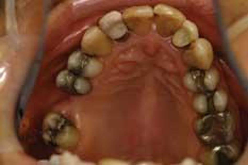 Dental All-Ceramic Dental Crown Prep - Bur Set (6 burs)
