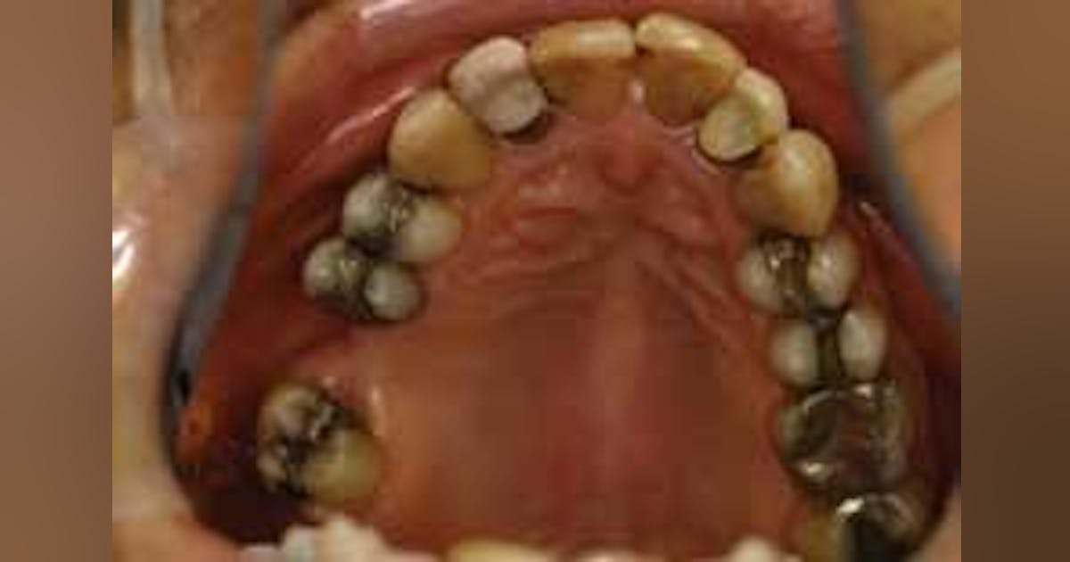 Dental All-Ceramic Dental Crown Prep - Bur Set (6 burs)