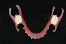 Valplast: Flexible, aesthetic partial dentures | Dental Economics