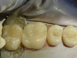 cerec crown cost without insurance