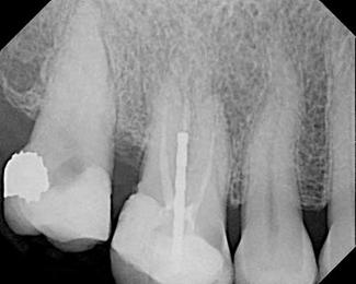 Endodontic treatment planning Reading the signs Dental Economics