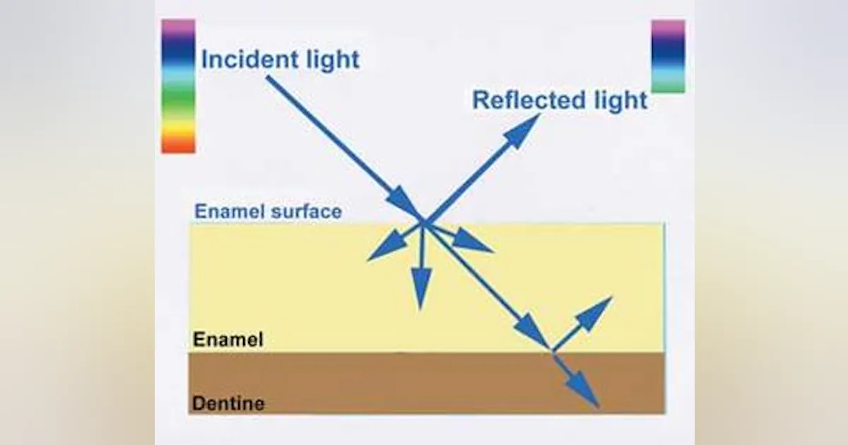 Tooth lightening A new concept for maximizing surface esthetics ...