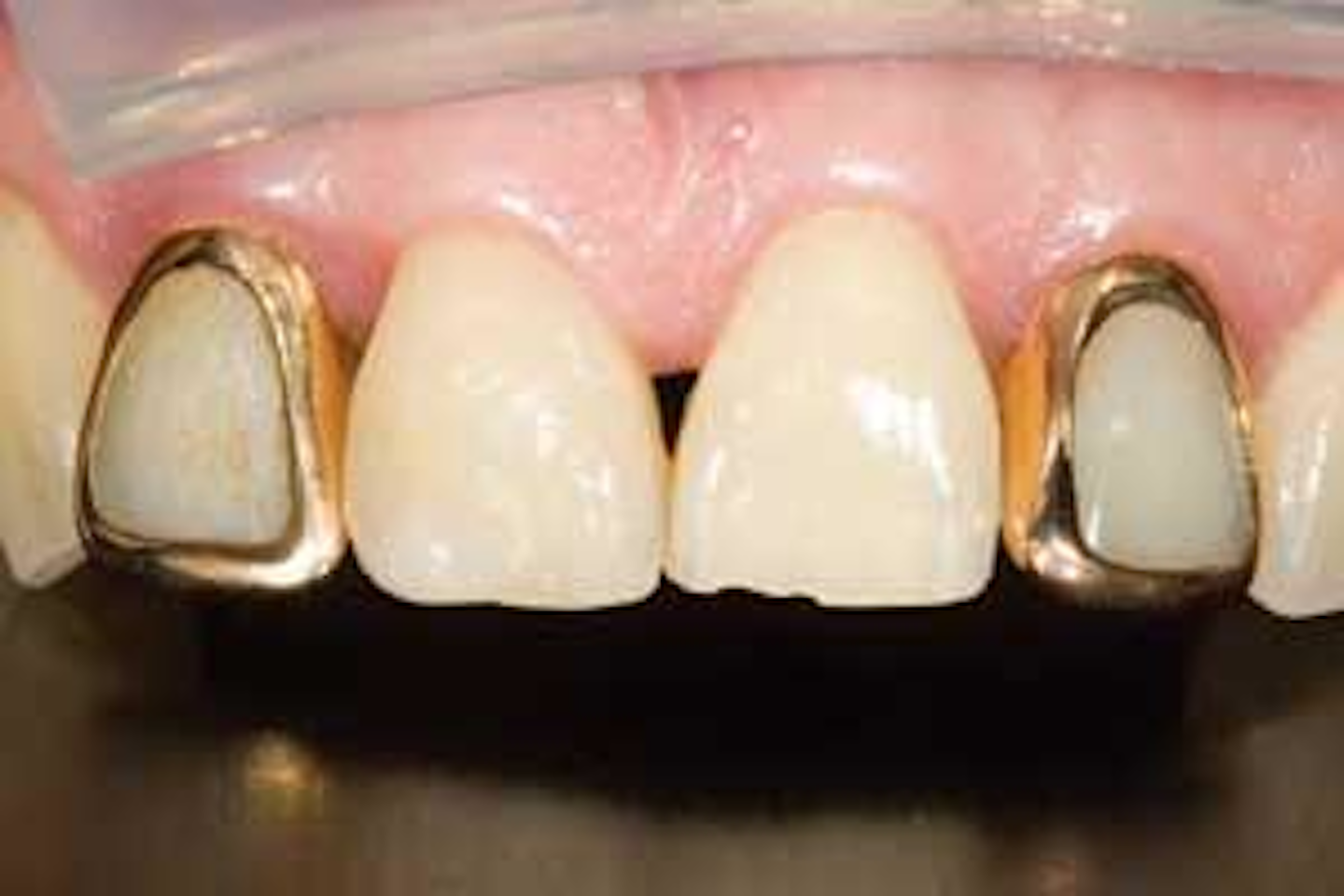 A quick look at the twocord impression technique Dental Economics