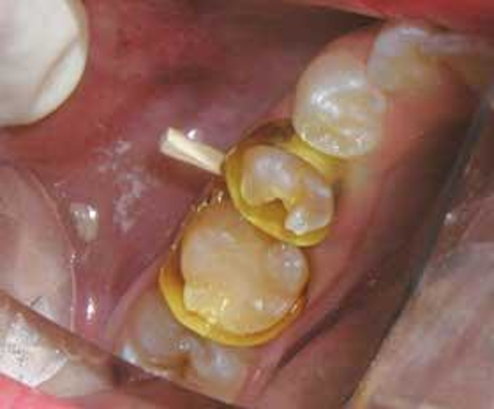 Matrix bands for primary and permanent Class II composite restorations Dental Economics