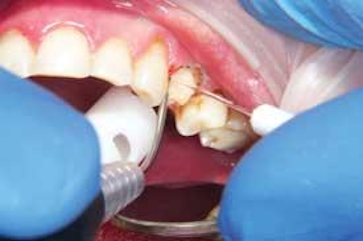 Soft tissue lasers It’s the wavelength, power, ergonomics, and control