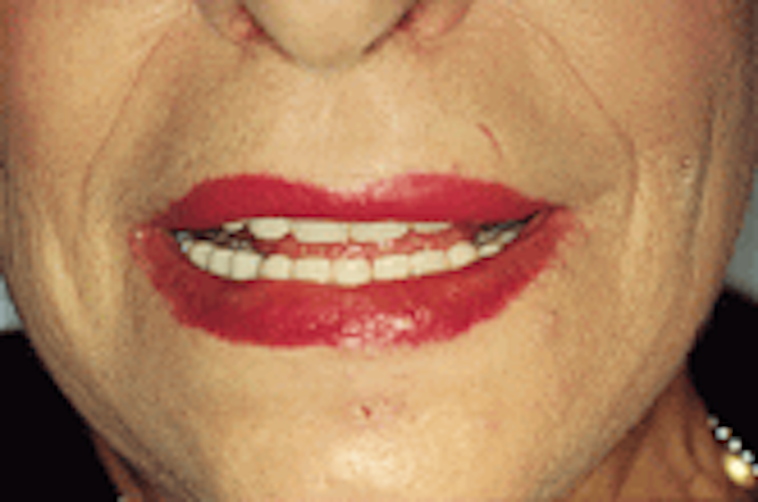 The successful mandibular denture implant-part two | Dental Economics