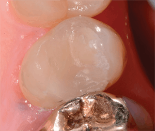 The problem with large metal (amalgam) fillings — Nova Smiles