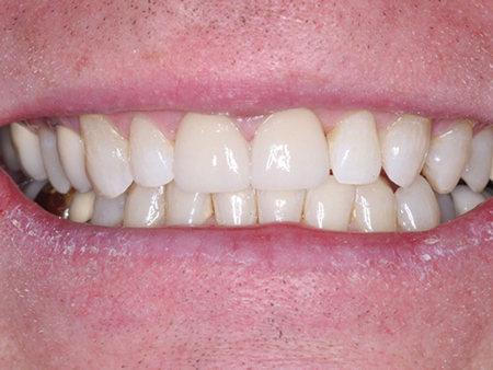 To Glaze Or Not To Glaze Dental Economics
