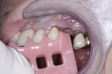 To Glaze Or Not To Glaze Dental Economics