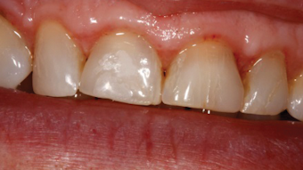 Hygiene And Lasers Dental Economics