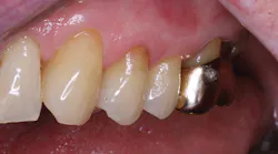 1611depla P01