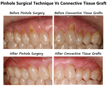 Pinhole Surgical Technique: Halting gingival recession in a single visit |  Dental Economics Pinhole Surgical Technique: Halting gingival recession in a single visit |  Dental Economics