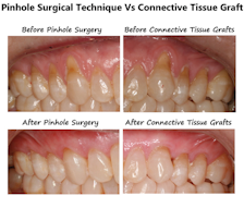 Bone Grafting After Tooth Removal Why When And What To Use Dental Economics
