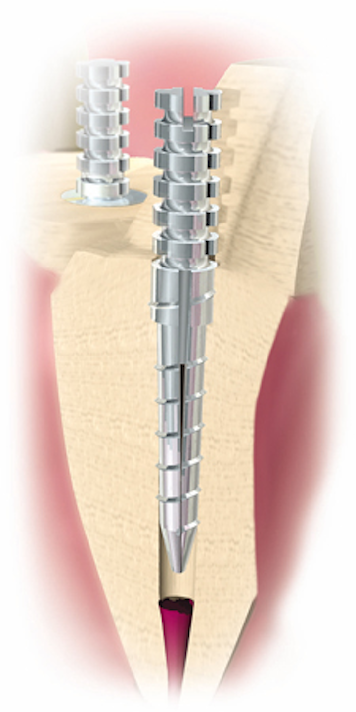 Endodontic posts Choosing the optimum material and design Dental