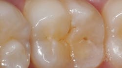 Occlusal view of tooth No. 30. Hidden caries is discovered with Diagnodent (KaVo Dental) that is not diagnosed with an explorer.