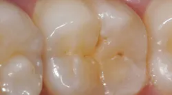 Occlusal view of tooth No. 30. Hidden caries is discovered with Diagnodent (KaVo Dental) that is not diagnosed with an explorer.