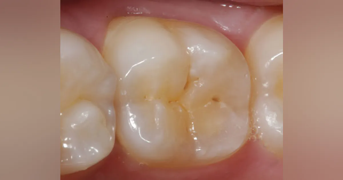 Pitty Teeth Pit Tooth Cavity