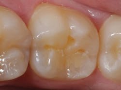Minimally invasive cavity preparations are performed with a fissurotomy bur (SS White) without the use of local anesthesia. Note how much healthy tooth structure remains as compared to a traditional G. V. Black-type of preparation design.