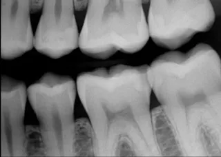 How does glutaraldehyde prevent postoperative tooth sensitivity ...