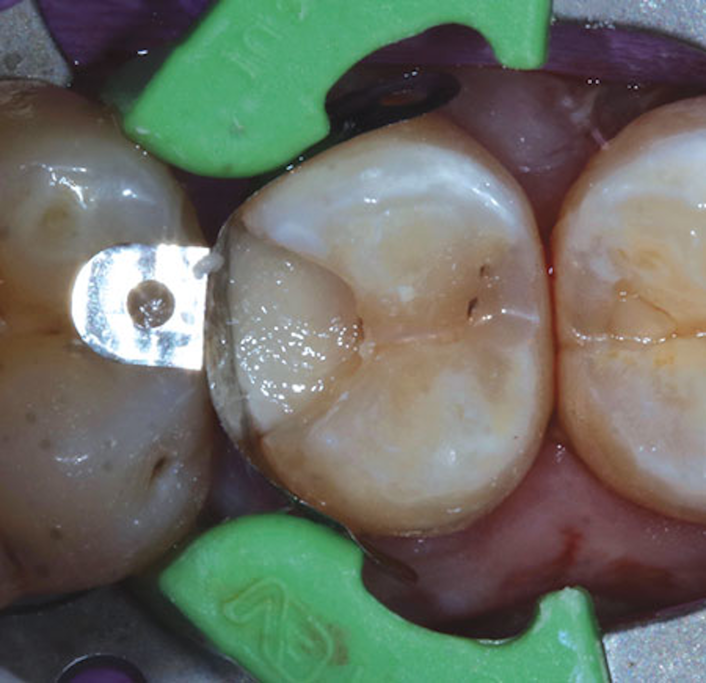 Resin-modified glass ionomer: The open sandwich technique | Dental ...