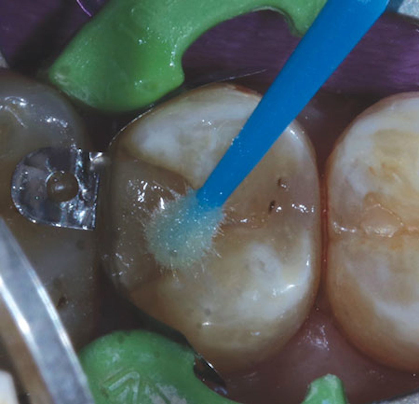 Resin-modified Glass Ionomer: The Open Sandwich Technique 