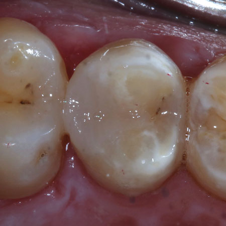 how long does a glass ionomer filling last