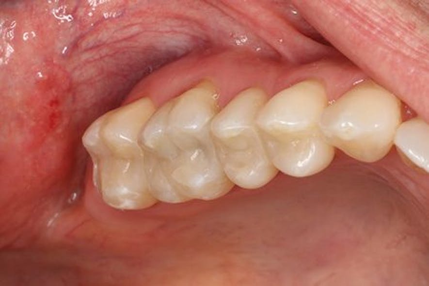 Ivoclar 1606deses P05 scale large png