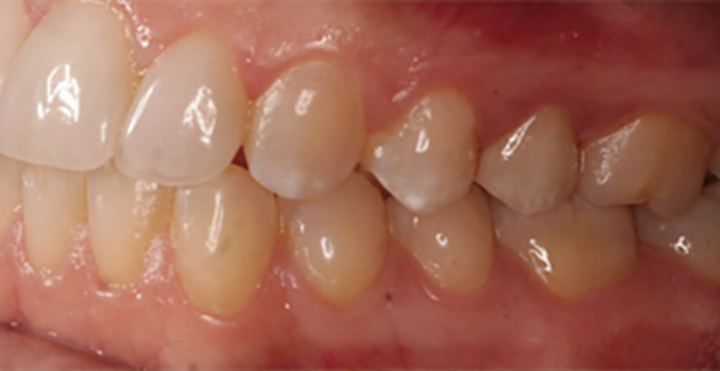 How To Reliably Bond Zirconia Dental Economics