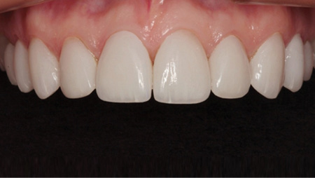 1711denas P14