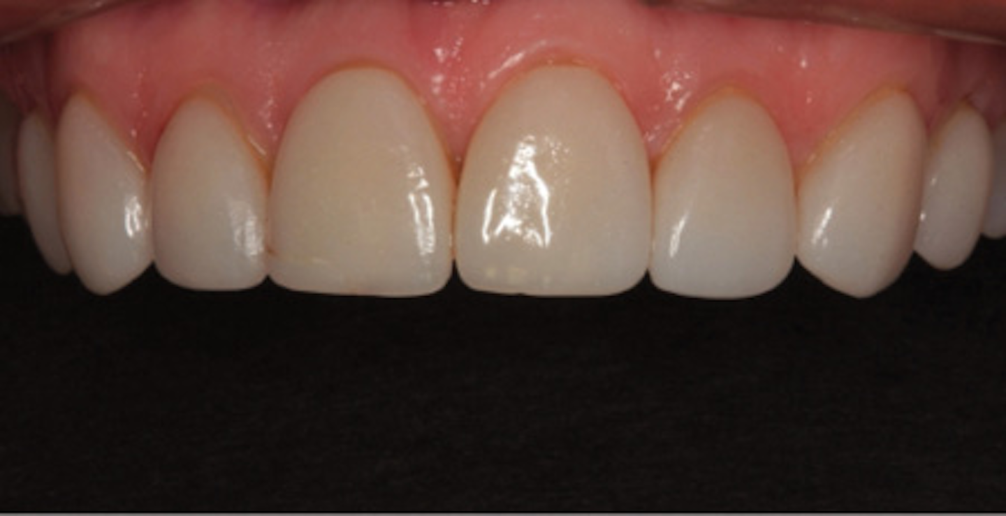 Minimally invasive thin veneers: Esthetics and longevity ... Minimally invasive thin veneers: Esthetics and longevity ...