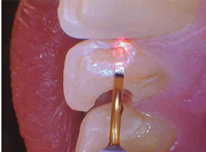Laser-assisted restorative dentistry: Can we afford not to use it? | Dental Economics Laser-assisted restorative dentistry: Can we afford not to use it? | Dental Economics