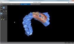 Implant Locking2 Implant Locking2