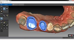 Restorativelocking1 Restorativelocking1