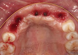 1805degle P11 1805degle P11