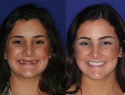 1805degle P17 1805degle P17