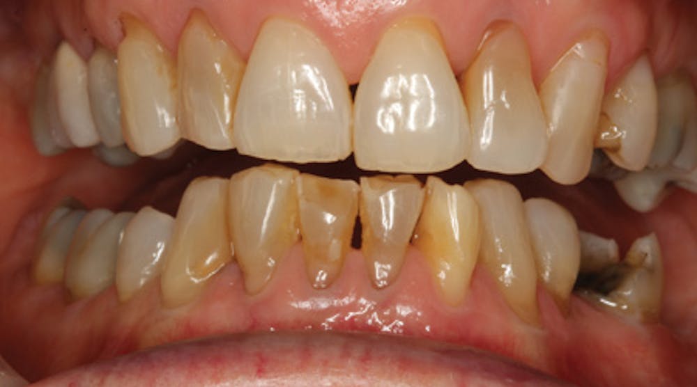 Bonding to lithium disilicate | Dental Economics