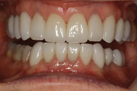 Bonding to lithium disilicate | Dental Economics