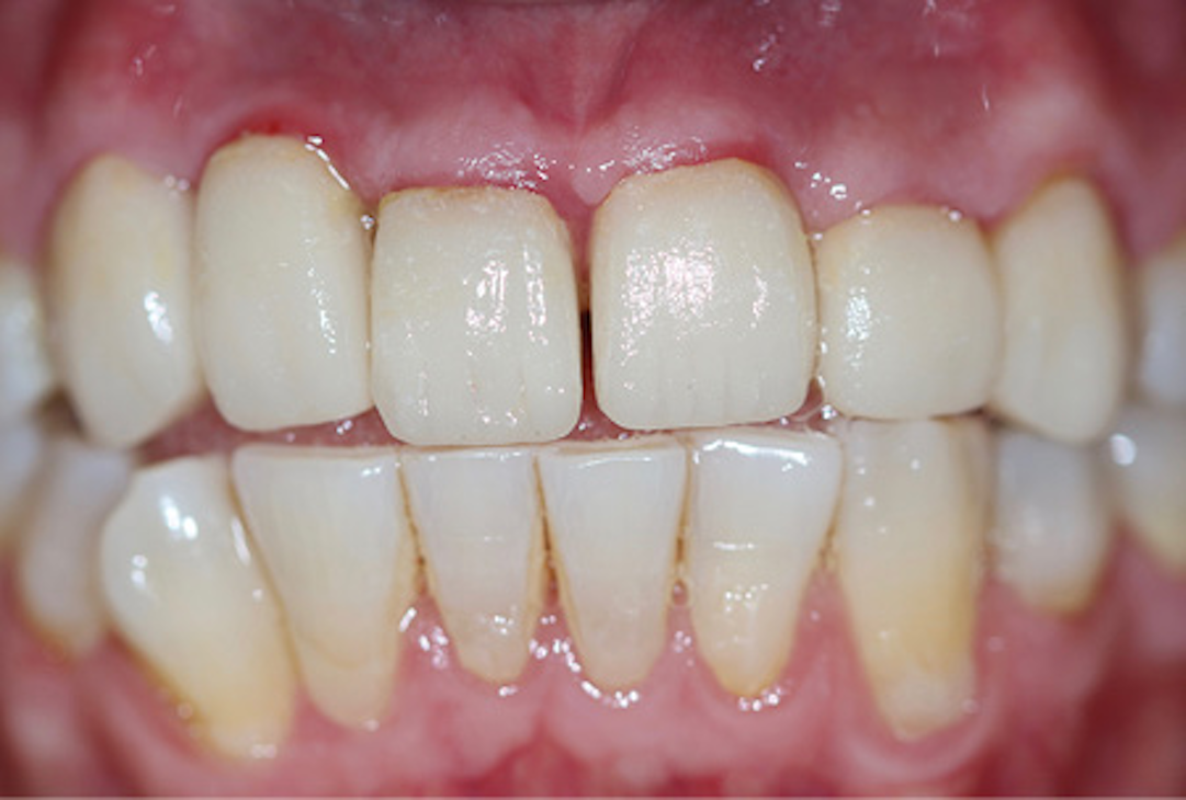 Impressions And Provisionals A Simplified Method For Crown And Bridge Dental Economics