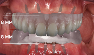 It S Time To End Your Love Affair With Dentures And Move On To Full Arch Dental Implant Restorations Dental Economics