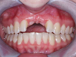 Pinhole Surgical Technique Halting Gingival Recession In A Single Visit Dental Economics