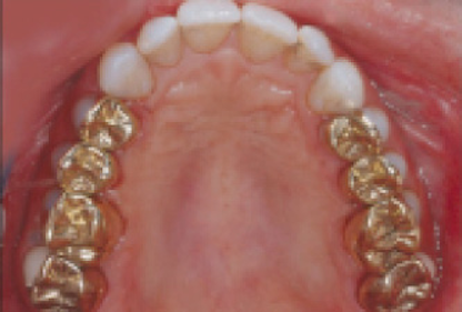 What Is The Best Type Of Material For Posterior Crowns Dental Economics