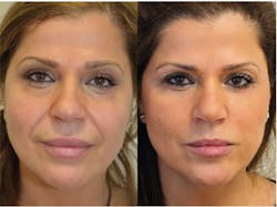 1811demal P01 1811demal P01