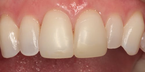 Direct composite veneers for esthetic reconstruction | Dental Economics