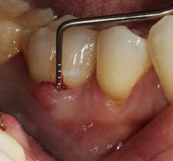 Figure 1: Molar with periodontal abscess due to furcation involvement Figure 1: Molar with periodontal abscess due to furcation involvement