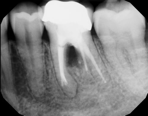 Figure 3: Tooth that would normally need to be extracted and replaced with an implant