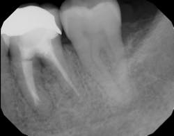 Figure 4: Same tooth one year later after laser detoxification and periodontal regeneration with growth-stimulating factors Figure 4: Same tooth one year later after laser detoxification and periodontal regeneration with growth-stimulating factors