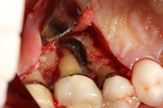 Figure 6: Molar tooth with three walls missing around the palatal root. This tooth would normally be extracted.